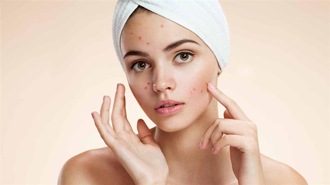 Woman with Acne