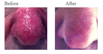 rosacea on nose before and after